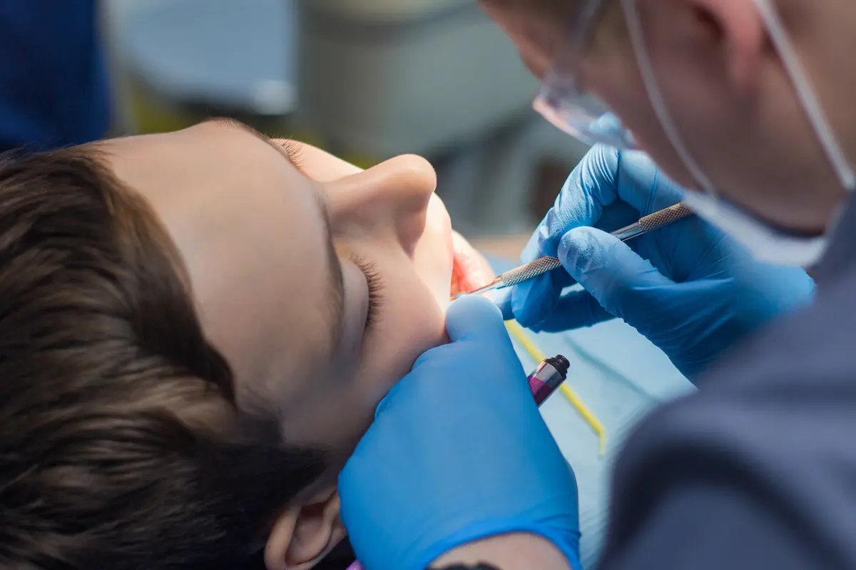 Dental Sealants
