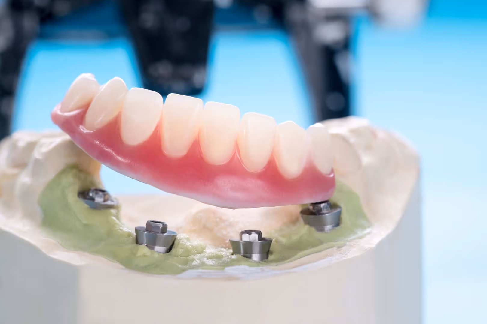 Implant-Supported Dentures