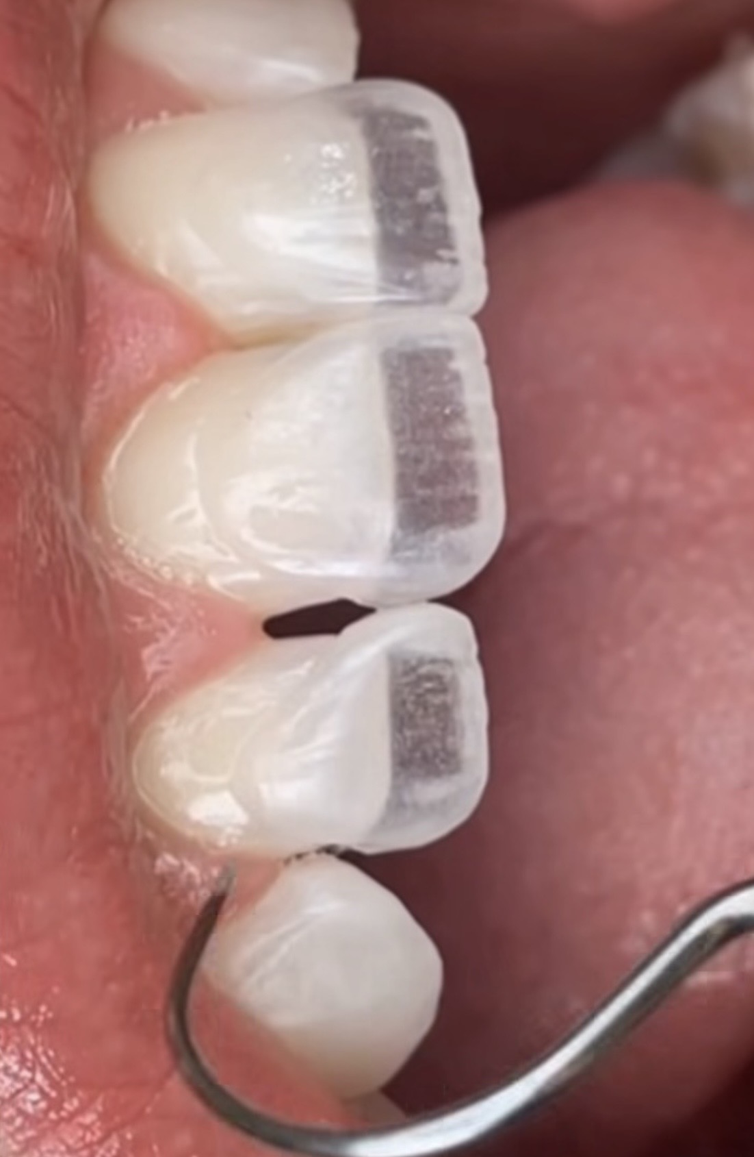 Ultra-thin porcelain veneers demonstrating natural tooth shape and translucency at Gen2 Dentistry
