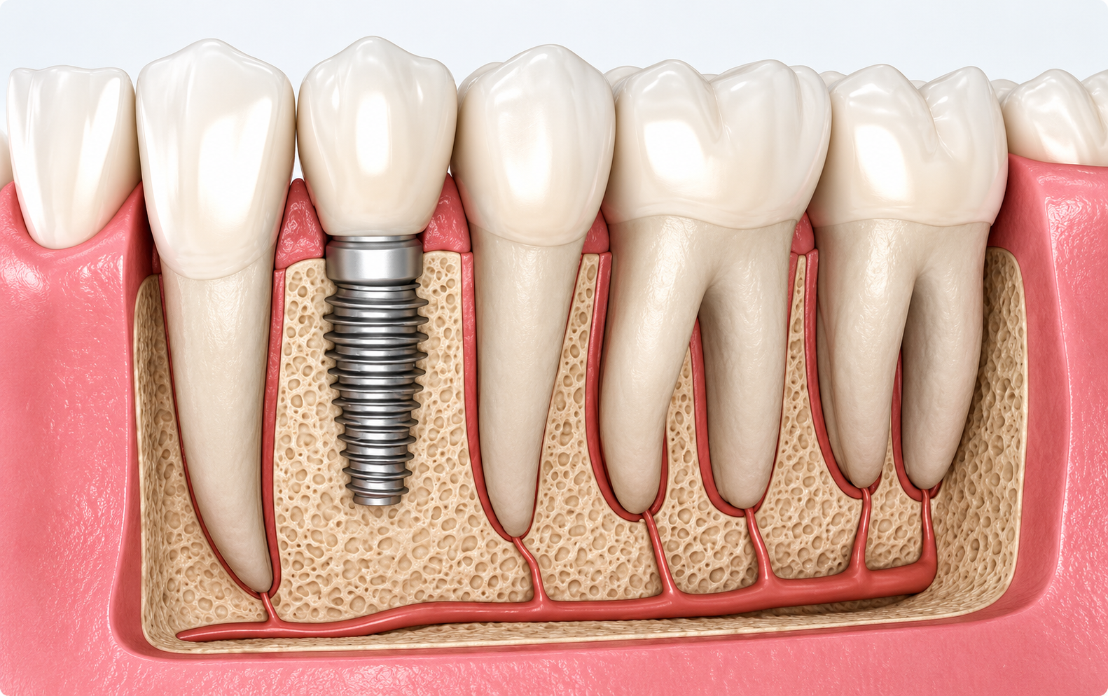 Dental implant illustration showing an implant-supported tooth replacing a missing tooth.