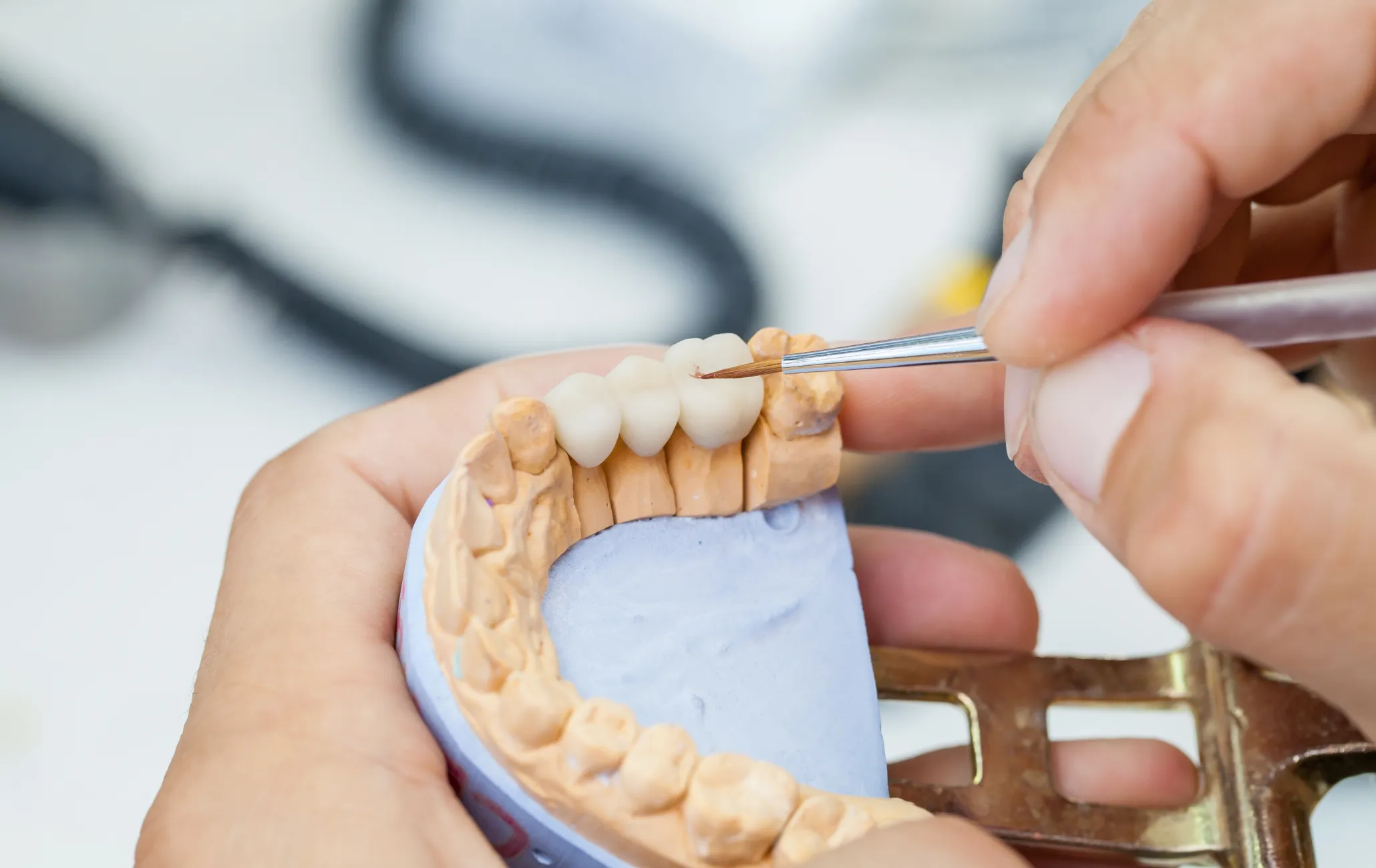 Davie, FL: Veneers vs. Crowns – Choosing the Best Dental Solution