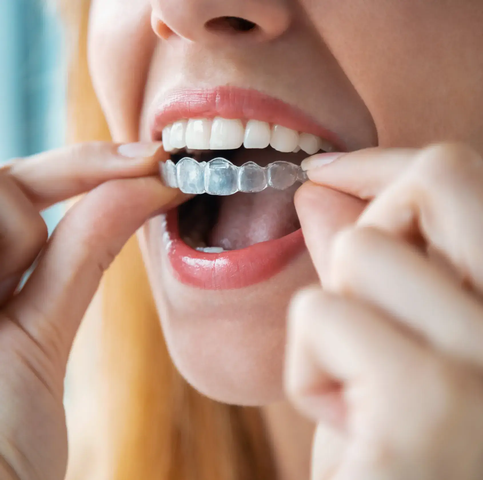 A woman is putting on a brace for her teeth.