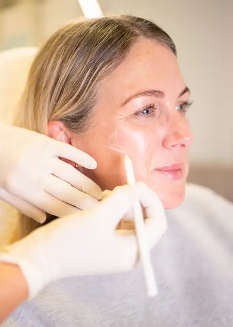 Practitioner marking up a client’s cheek before an aesthetic treatment