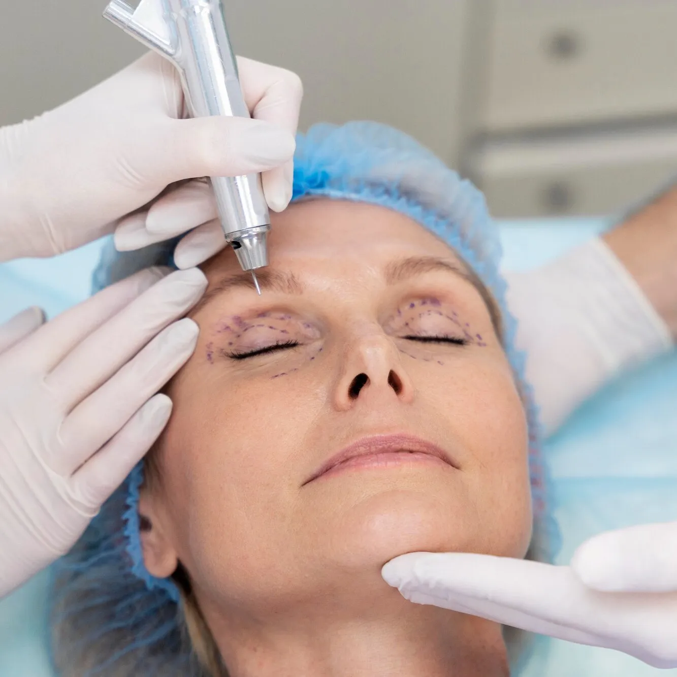 Upper blepharoplasty