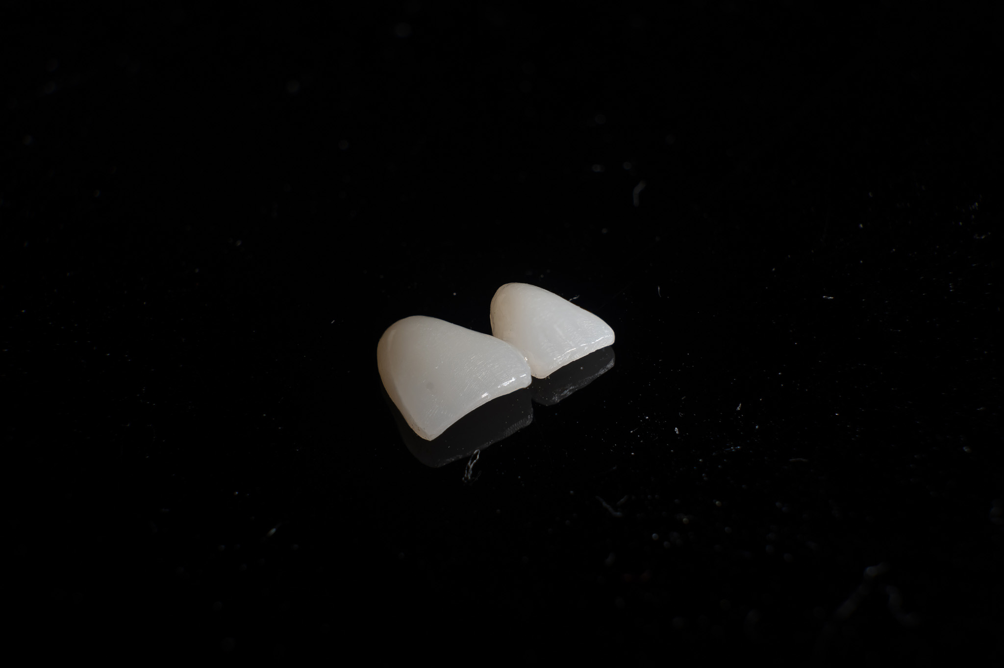 dental veneer