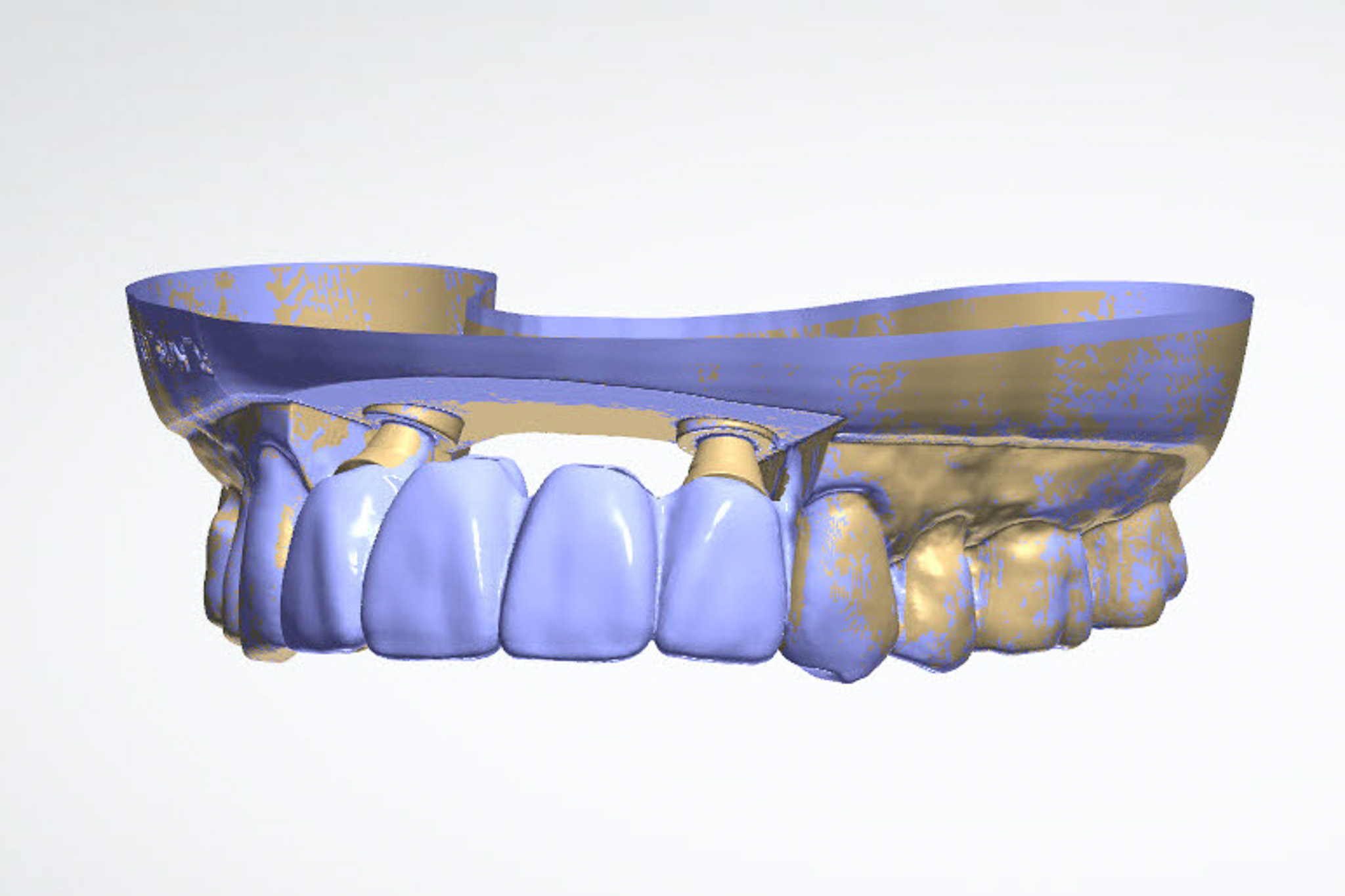 Digital Wax Up