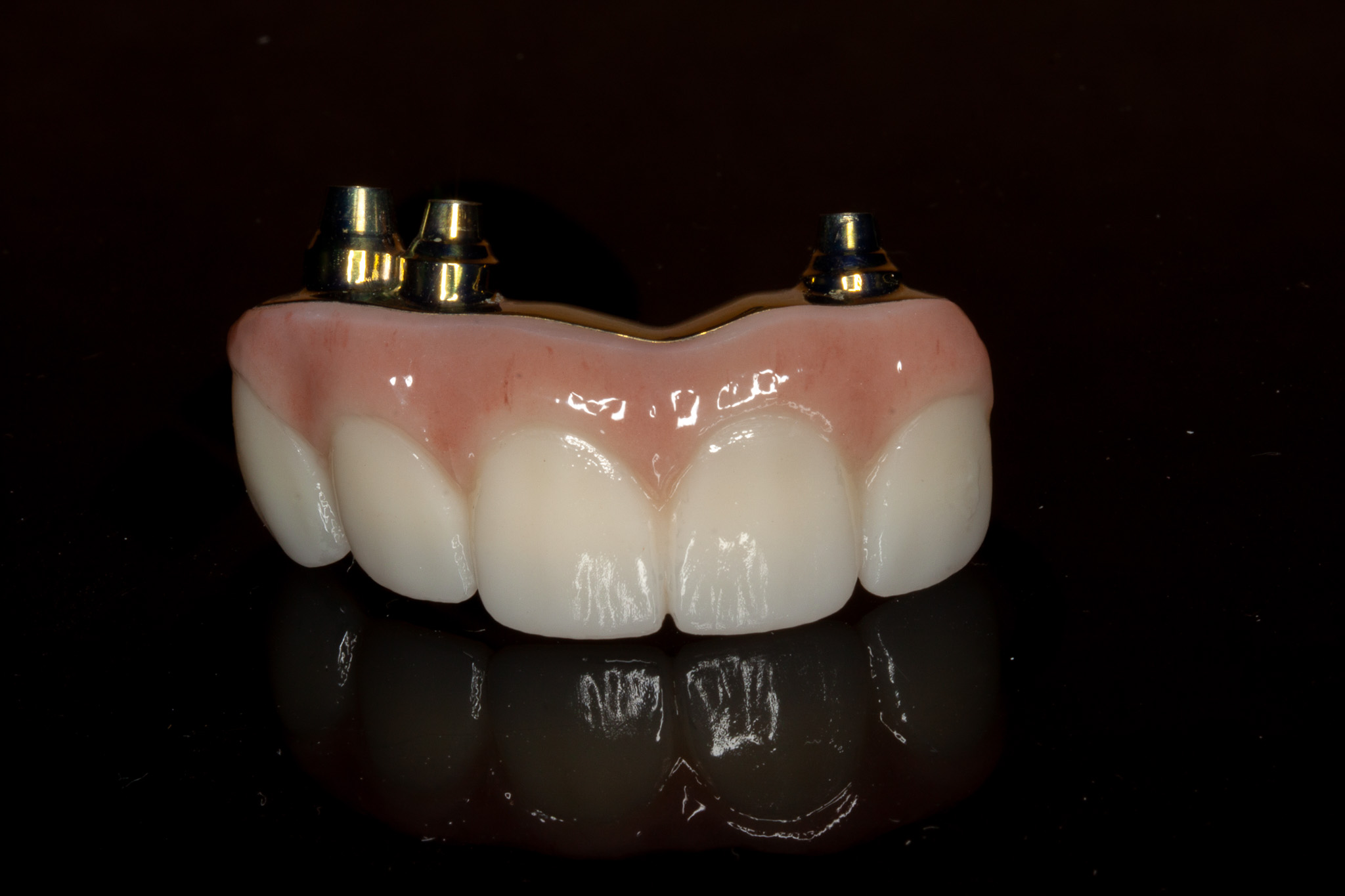 dental bridge