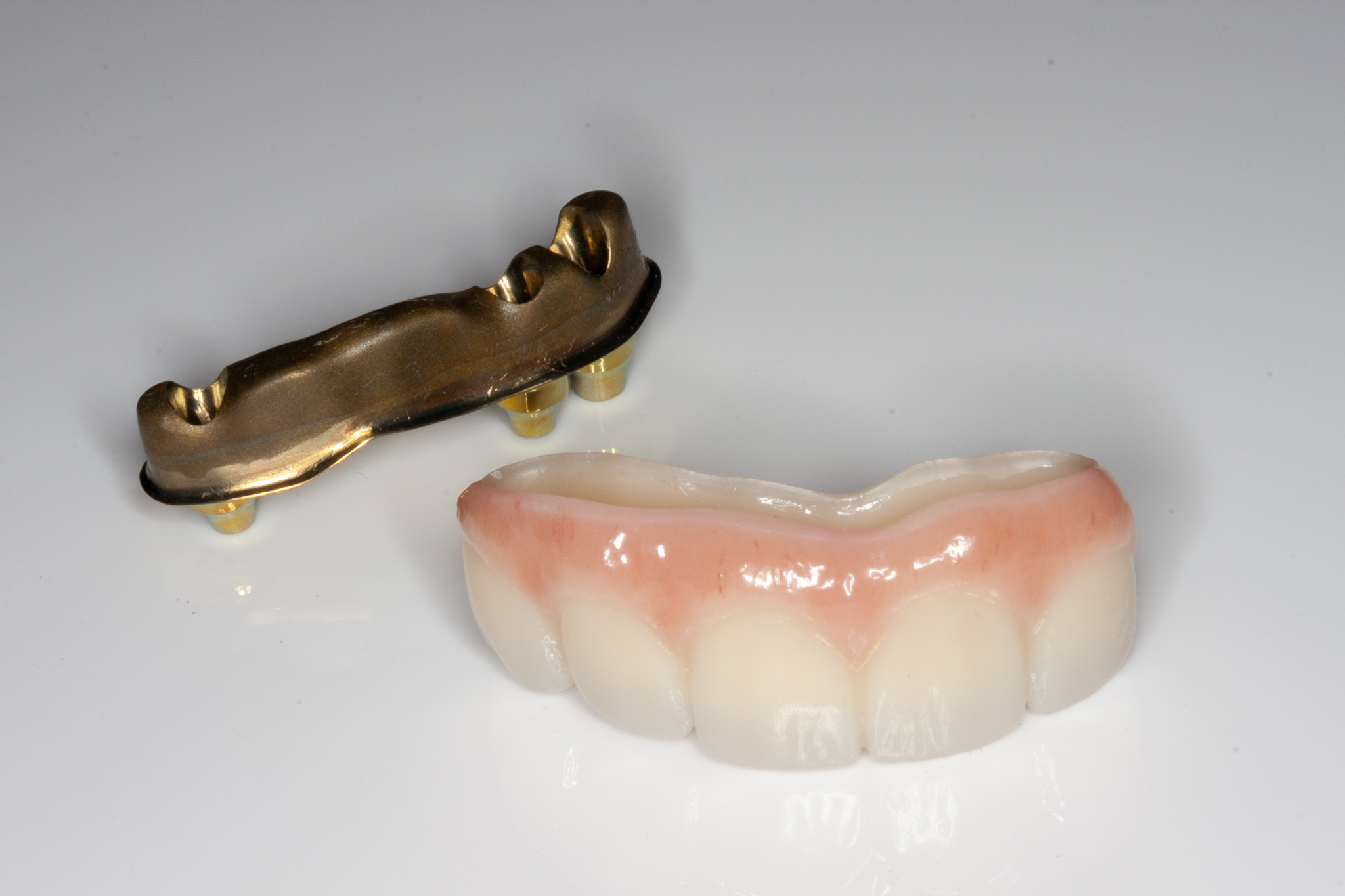 dental bridge