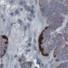 Virtual AMACR/p63/CK5/14 stain