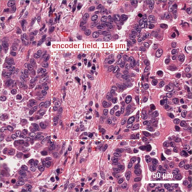 Routine H&E tile of lung adenocarcinoma with the central 114 µm field outlined