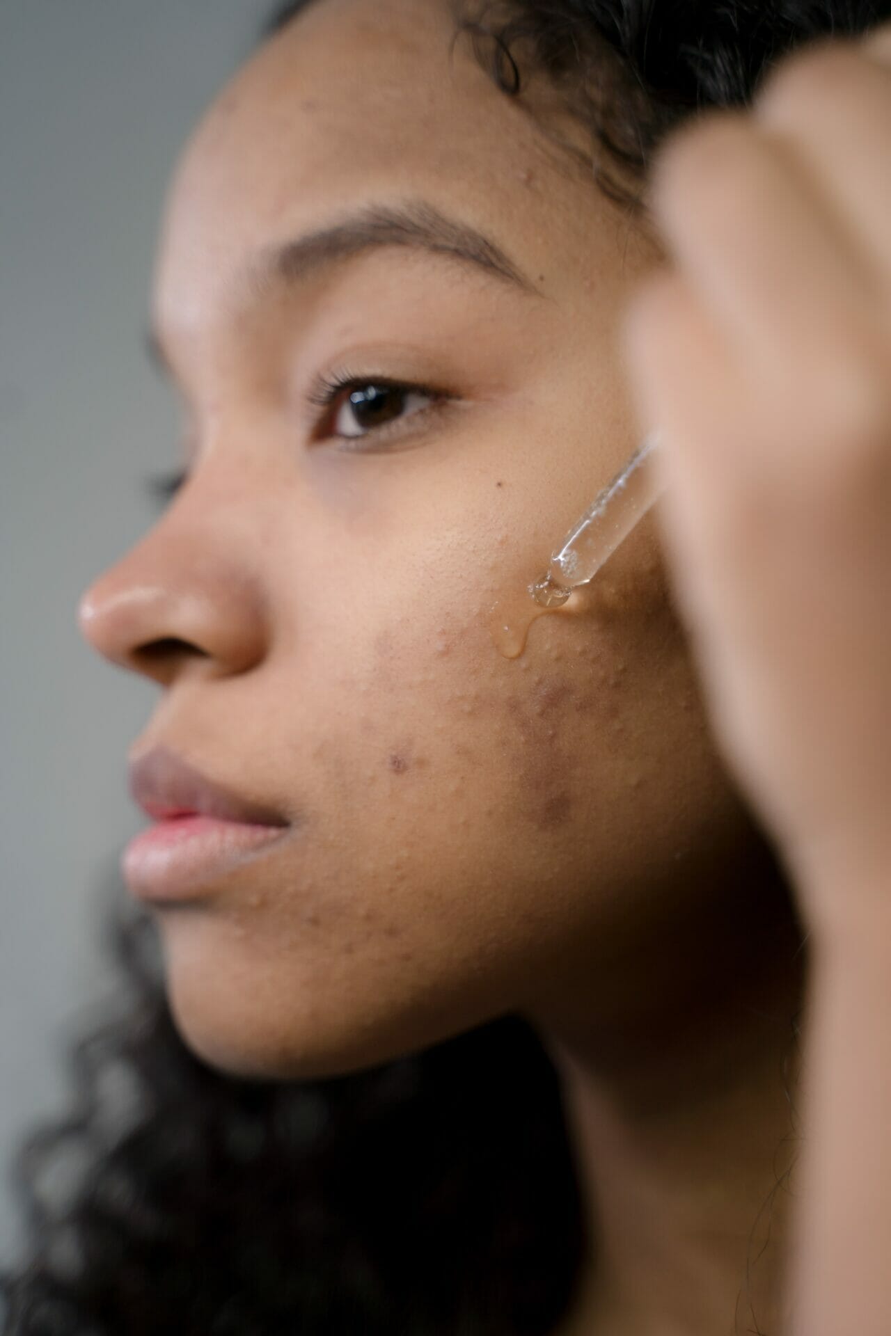 A woman applies a facial serum to her acne spots. 