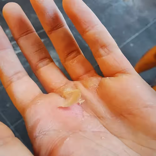 hand treatment crossfit