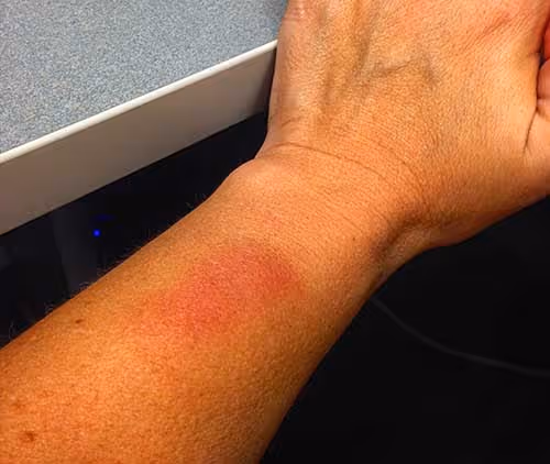 Kettlebell wrist bruises