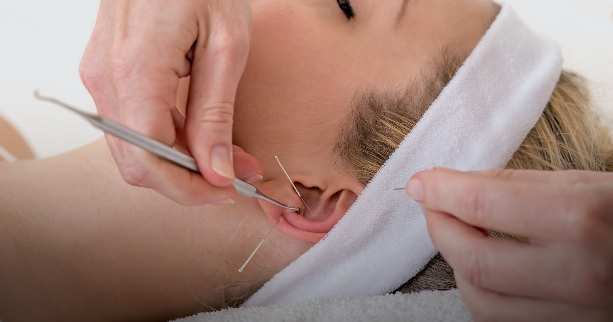 Eine Nahaufnahme einer Frau mit geschlossenem Auge, die Ohrakupunktur mit feinen Nadeln erhält. Eine Person führt die Behandlung mit einem Instrument durch.