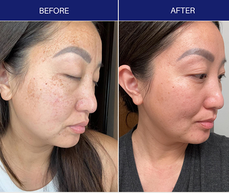 Side-by-side comparison of a woman's face showing before and after skin treatment, with reduced dark spots and smoother complexion in the after photo.