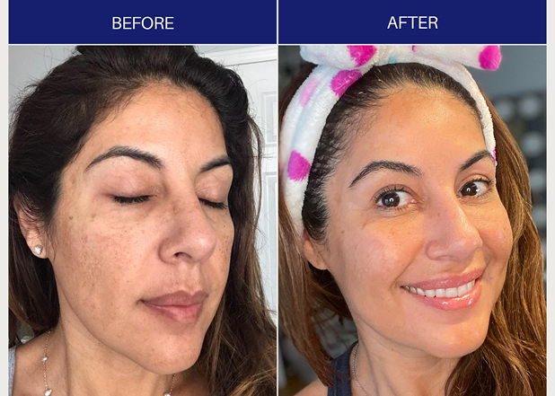 Side-by-side before and after images of a woman showing improved skin clarity and brightness after treatment.