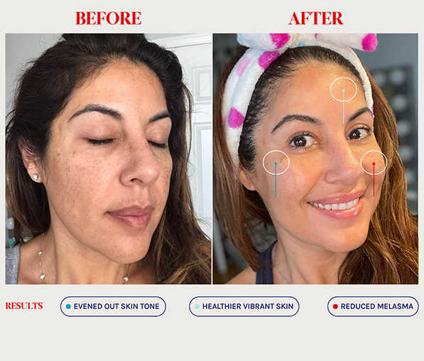 Comparison of a woman's face before and after treatment showing evened skin tone, healthier vibrant skin, and reduced melasma.