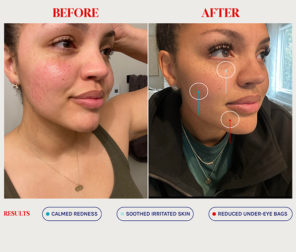 Side-by-side before and after photos of a woman's face showing skincare results: reduced redness and irritation, and diminished under-eye bags.