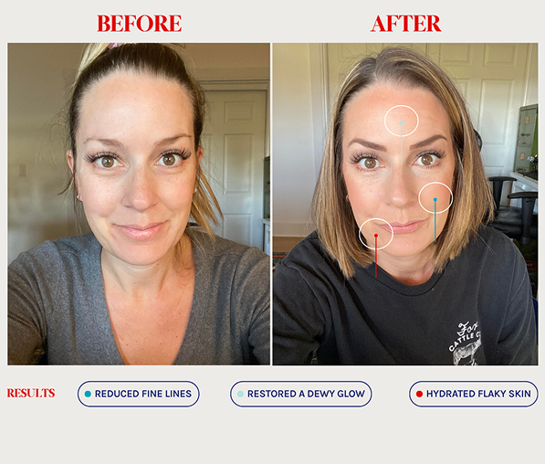 Side-by-side before and after photos of a woman's face showing reduced fine lines, restored dewy glow, and hydrated flaky skin after treatment.