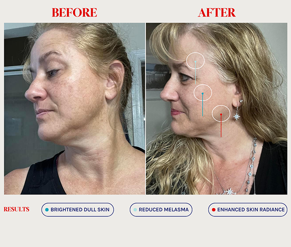 Side-by-side before and after photos of a woman’s face showing skin improvements: brighter skin, reduced melasma, and enhanced radiance.