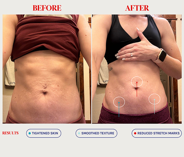 Side-by-side comparison of a woman's abdomen before and after treatment showing tightened skin, smoothed texture, and reduced stretch marks in the after image.