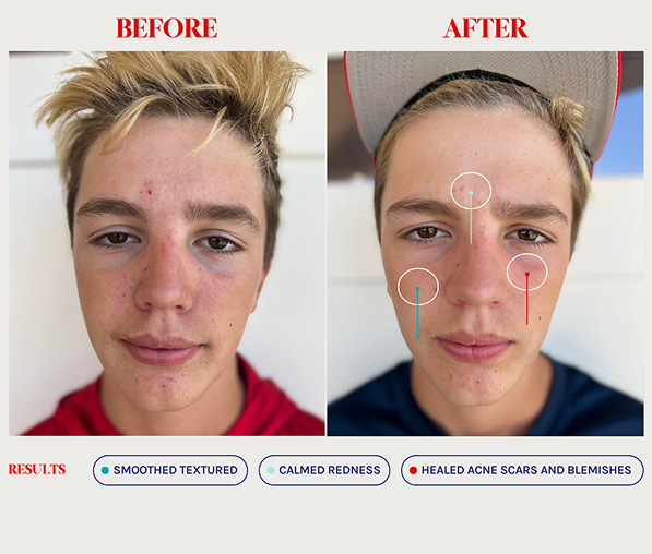 Side-by-side before and after photos of a young man showing improved skin texture, reduced redness, and healed acne scars and blemishes.