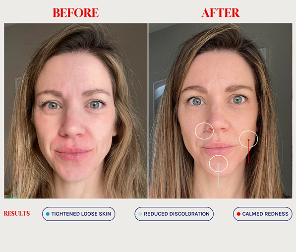 Side-by-side before and after images of a woman showing tighter skin, reduced discoloration, and calmer redness on her face.