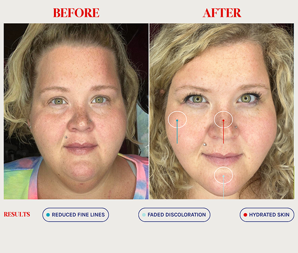 Side-by-side close-up photos of a woman’s face labeled Before and After, showing reduced fine lines, faded discoloration, and hydrated skin in the After image.