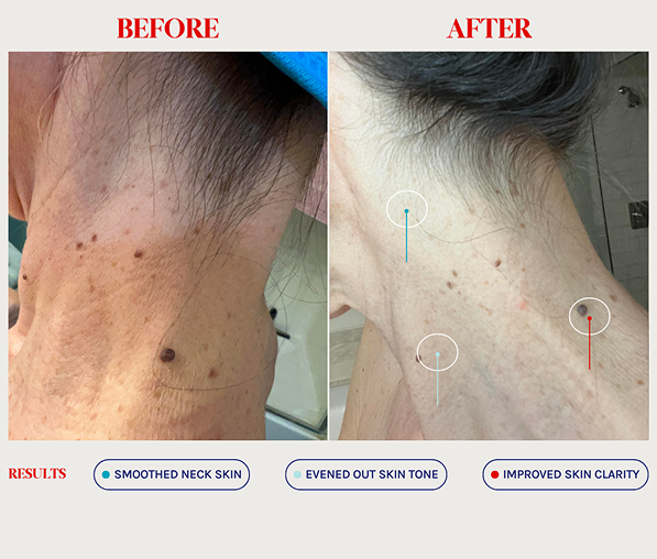 Side-by-side before and after photos showing a person's neck with visible dark spots and uneven skin tone before, and smoother, clearer, and more even-toned skin after treatment.