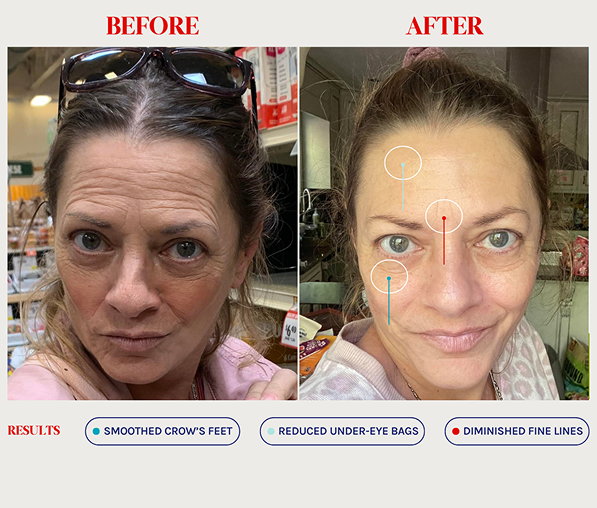 Side-by-side before and after photos of a woman showing skincare results with reduced crow's feet, diminished fine lines, and less under-eye bags.
