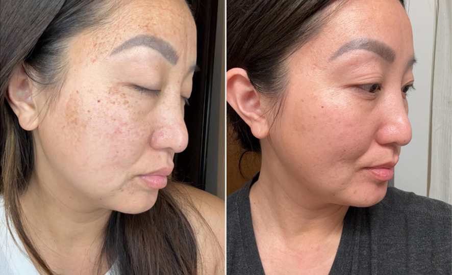 Side-by-side photos showing a woman's face with noticeable pigmentation and freckles on the left and a clearer complexion with reduced pigmentation on the right.