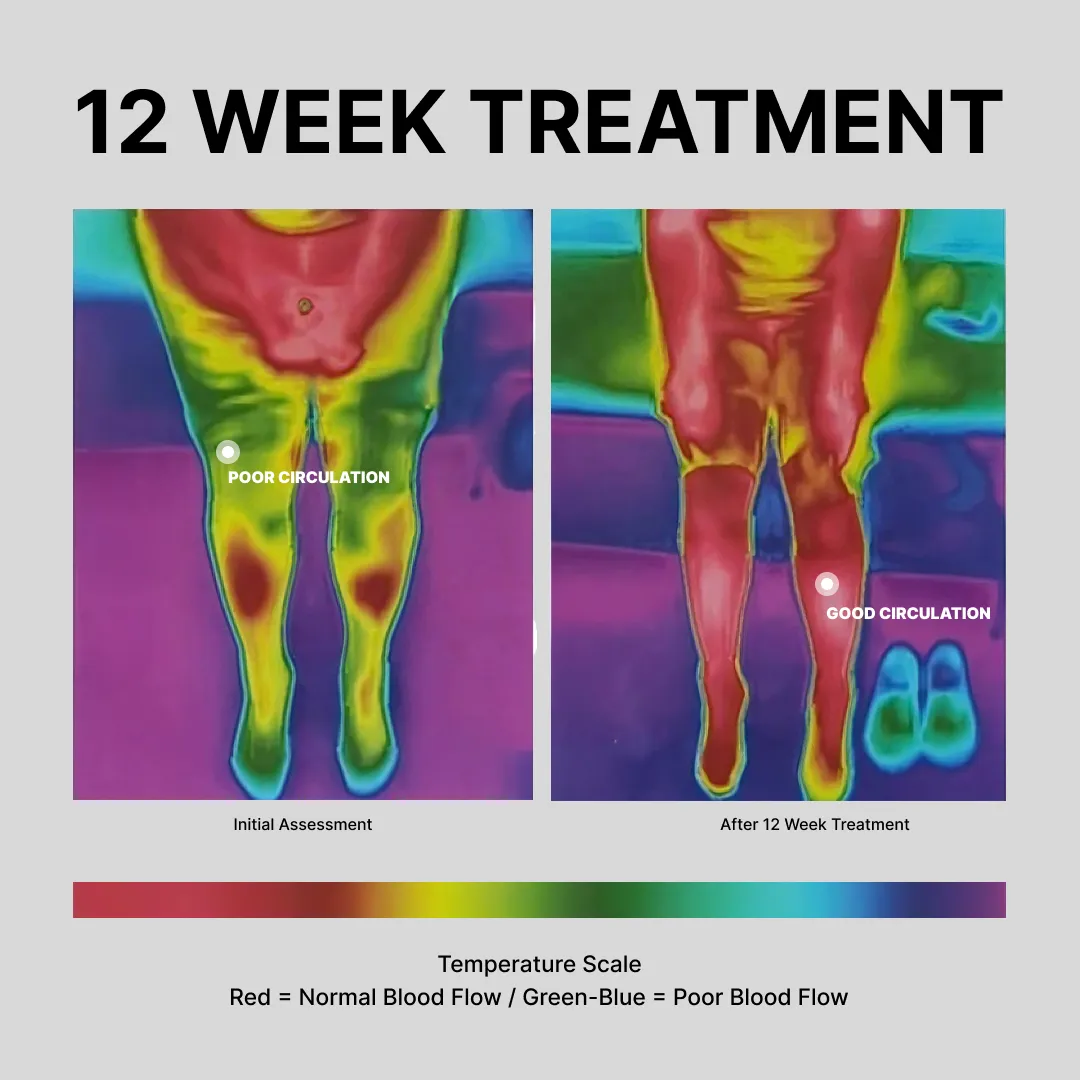 A comparative thermal imaging chart showing the results of a 12-week treatment with 'poor circulation' on the left and 'good circulation' on the right, used to indicate improved blood flow after treatment.