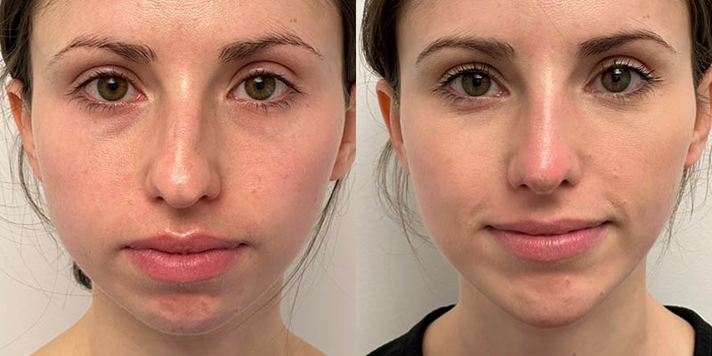 Rhinoplasty Before and After
