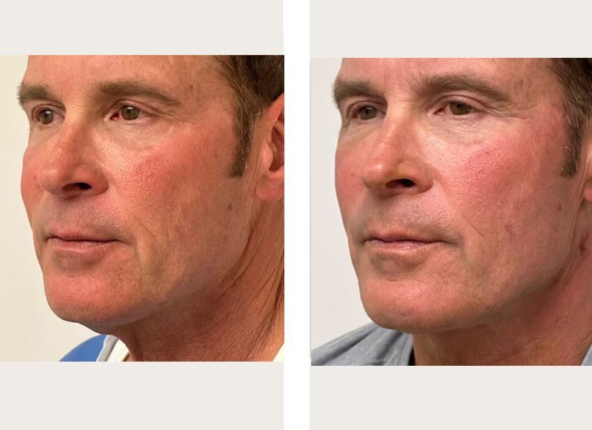 Threadlift before and after.