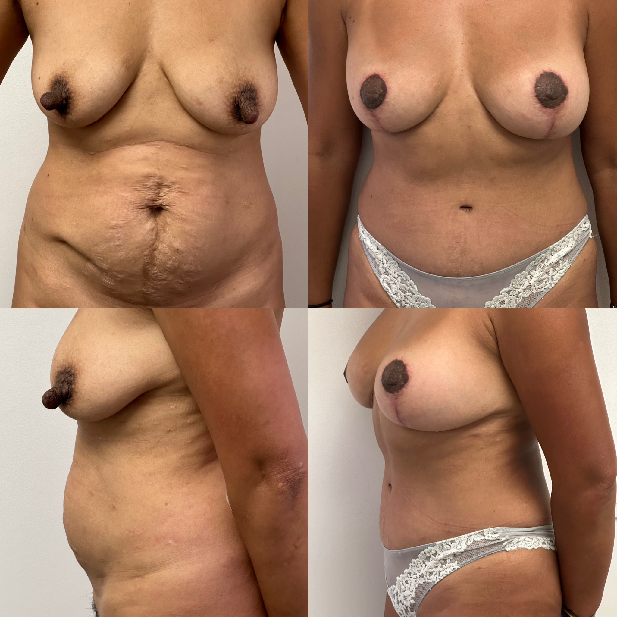 Breast Augmentation Before and After