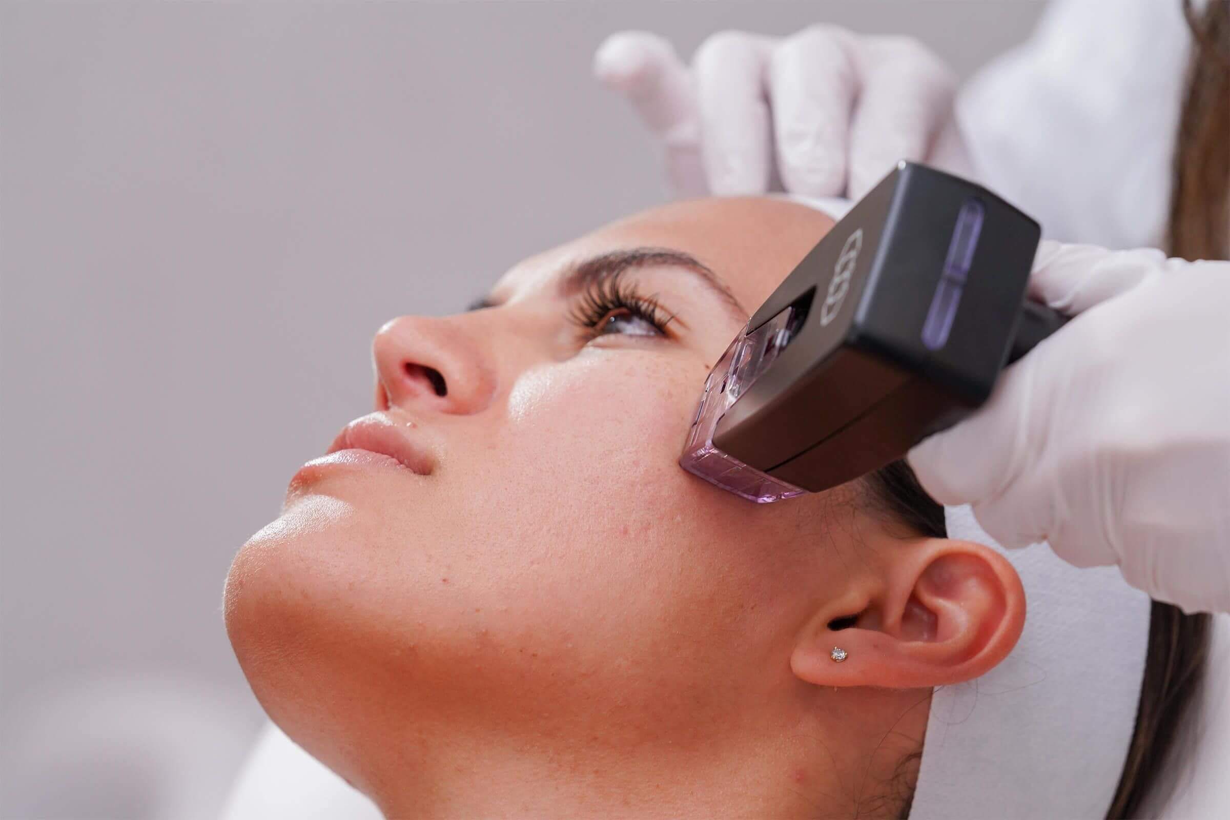 Face Morpheus8 treatment.