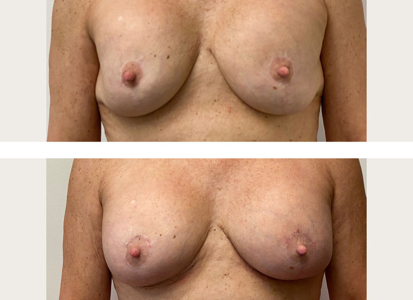 Breast before and after