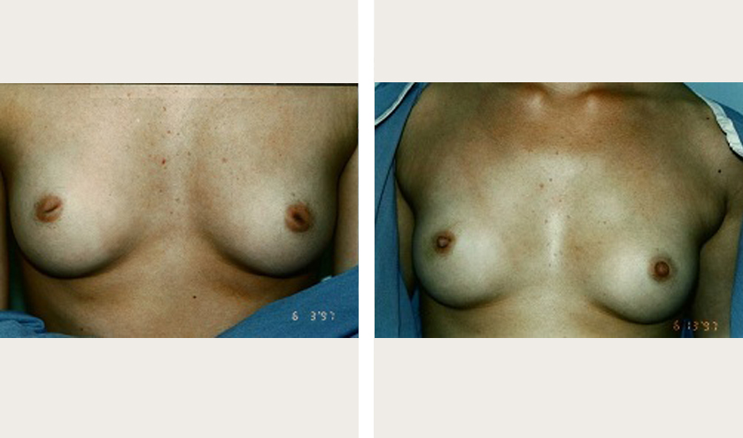 Inverted Nipple Before and After