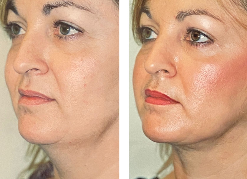 Neck Liposuction before and after