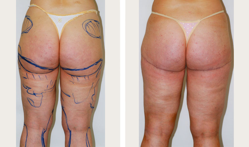 Brazilian Butt Lift before and after comparison.