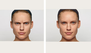 galderma-botox-holly