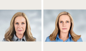 galderma-sculptra-elissa