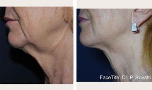 facetite-neck-bna1