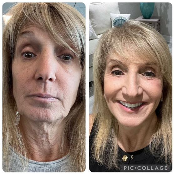 Facelift (Rhytidectomy)