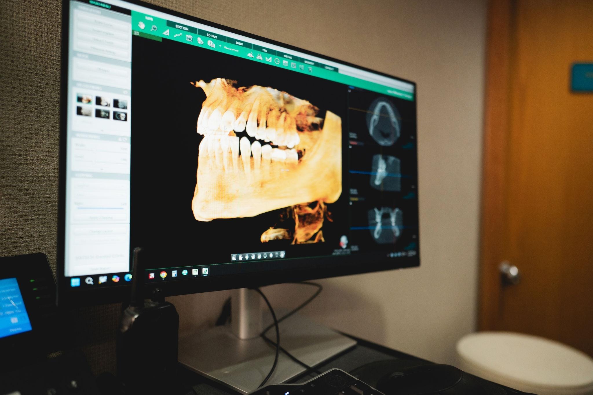 Bone grafting procedure preparation at Westfield Smiles dental office in New Jersey for dental implants