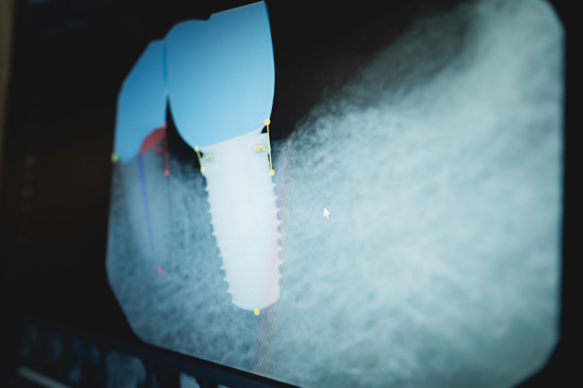Dental X-ray showing implant placement in jaw bone structure