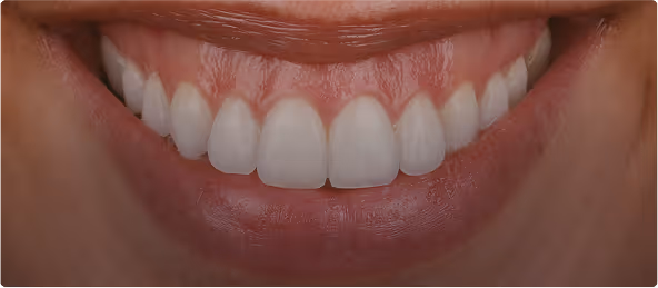 Sorriso Gengival: quais as causas e como resolver