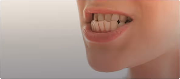  Prognatismo Mandibular: Tudo que você precisa saber [escrito por especialista]