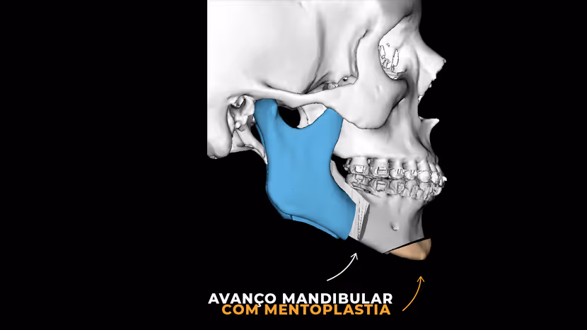 Como aumentar o queixo?