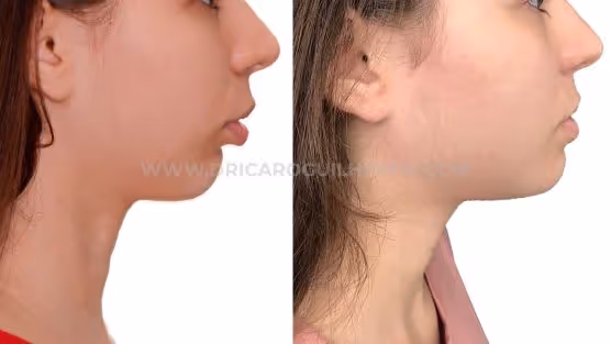 Resultado rápido com cirurgia ortognática é possível?